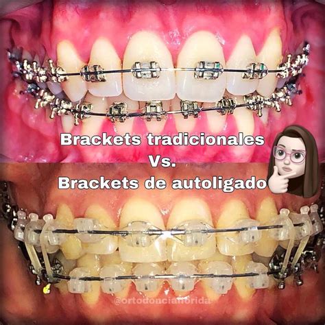 bracket metalico|que es un bracket.